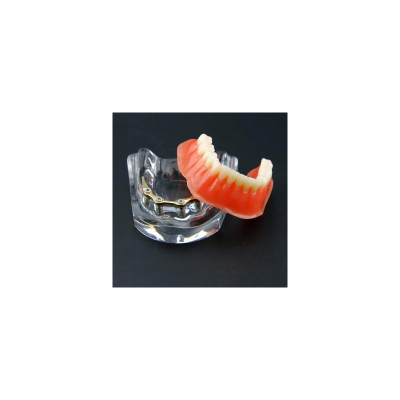 Dental Sobredentadura Typodont Modelo Inferior Precision Implant Dorado #6009